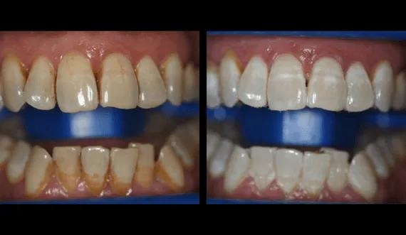 Teeth whitening (2)