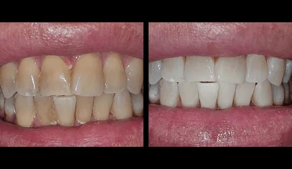 Teeth whitening (3)