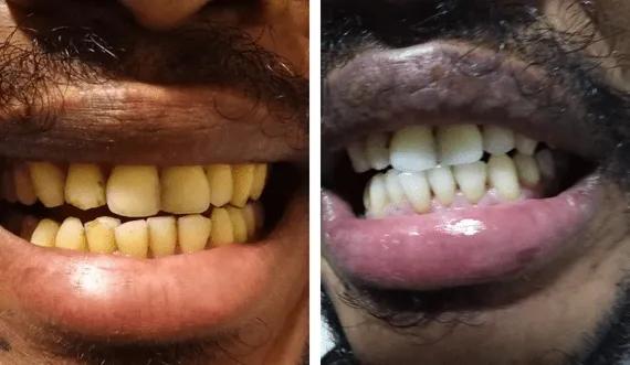 Teeth whitening (4)