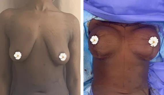 Breast lift with implants (1)