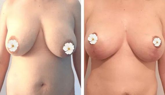 Breast lift with implants (2)
