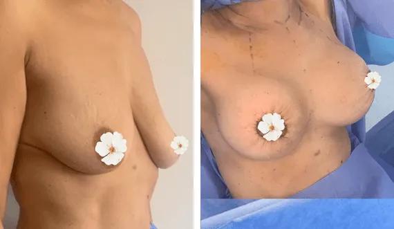 Breast lift with implants (3)