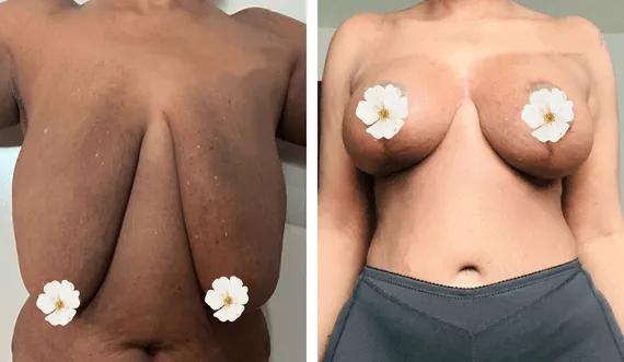 Breast lift with implants (4)