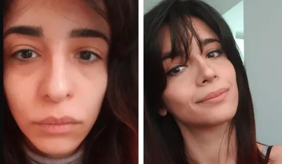 rhinoplastie