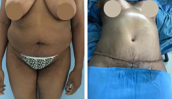 Abdominoplasty-tummy tuck (8)