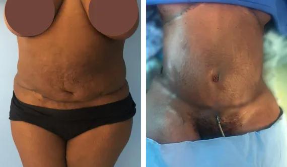 Abdominoplasty-tummy tuck (7)