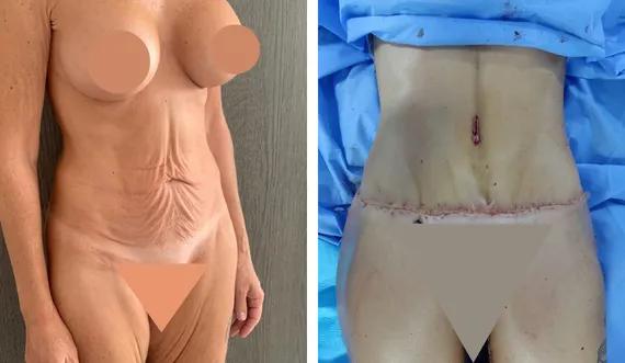 Abdominoplasty-tummy tuck (5)