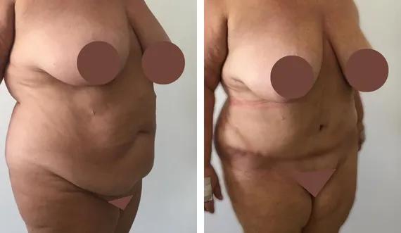 Abdominoplasty-tummy tuck (6)