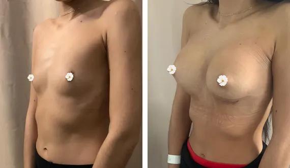 Breast augmentation (5)