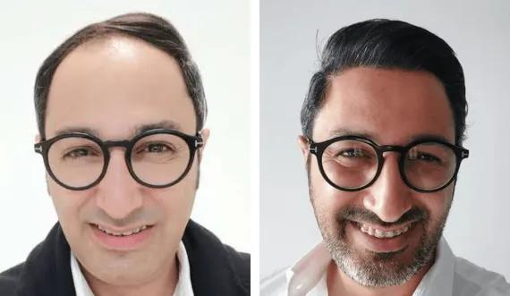 Hair implant FUE Saphir (1)