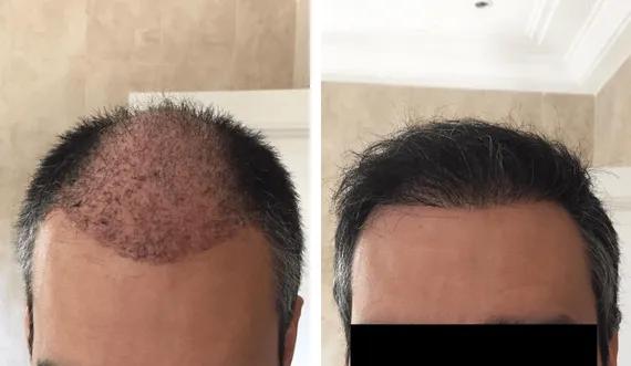 Hair implant FUE Saphir (2)