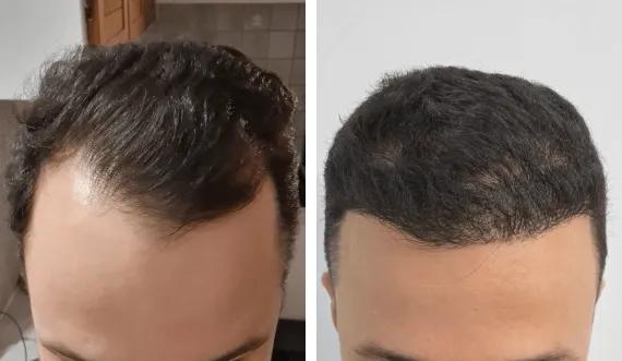Hair implant FUE Saphir (8)