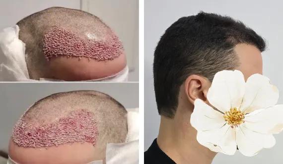 Hair implant FUE Saphir (3)