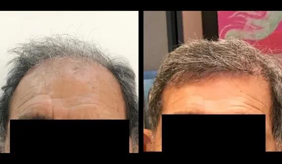 Hair implant FUE Saphir (4)