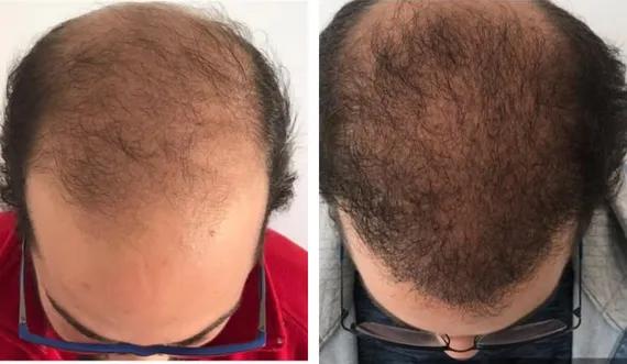 Hair implant FUE Saphir (5)