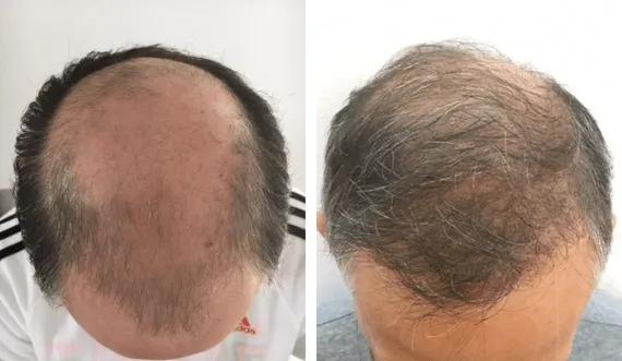 Hair implant FUE Saphir (6)
