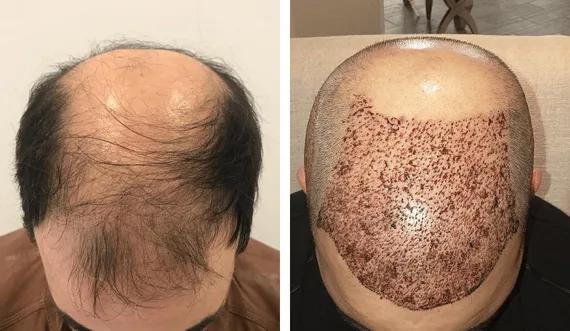 Hair implant FUE Saphir (7)