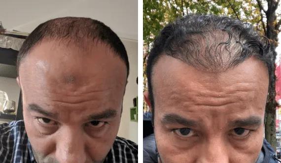 Hair implant FUE Saphir (10)