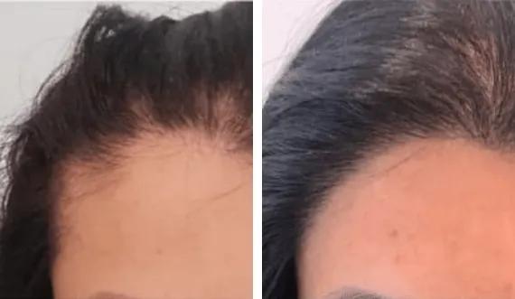 Hair implant FUE Saphir (11)