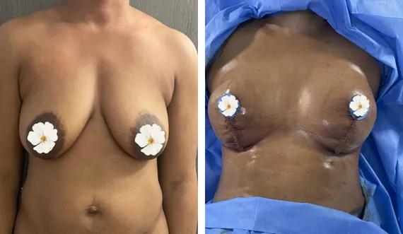 Breast lift with implants (6)