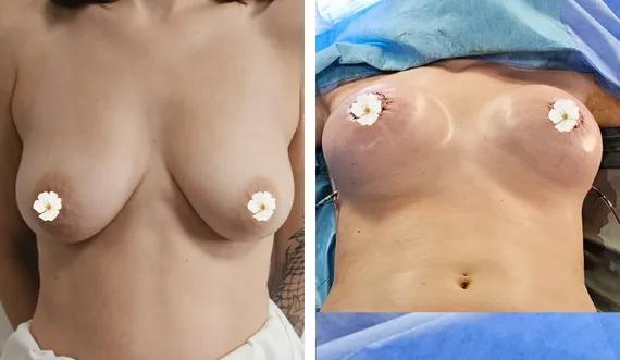 Breast lift with implants (7)