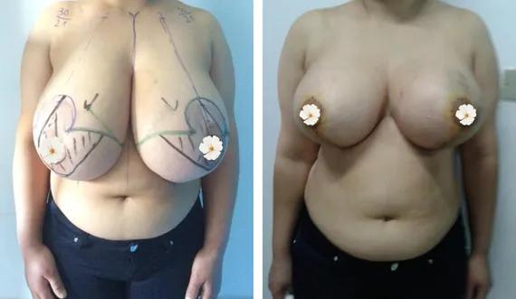 Breast reduction (2)