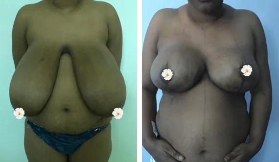 Breast reduction (3)