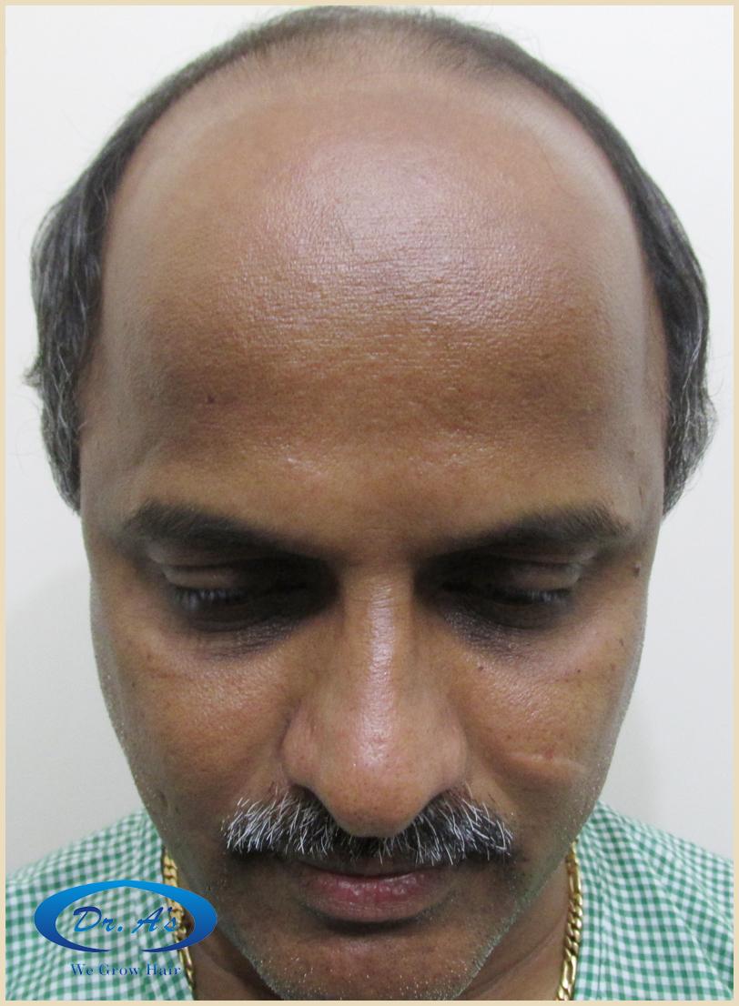 Before picture 242_49