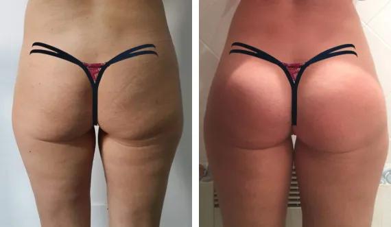 Buttocks implants (1)