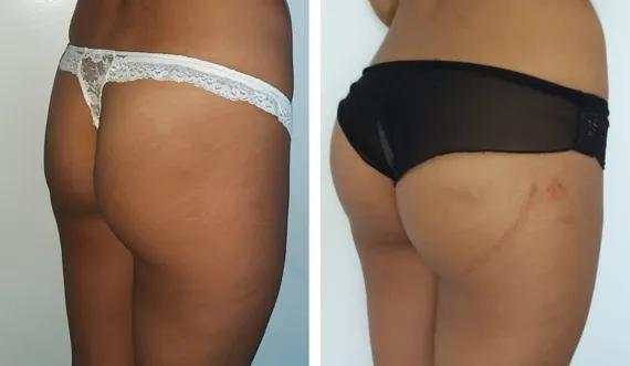 Buttocks implants (2)