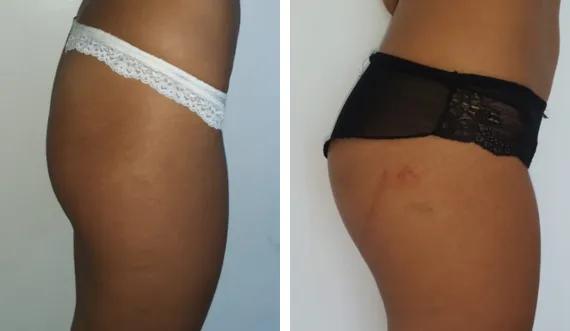 Buttocks implants (4)