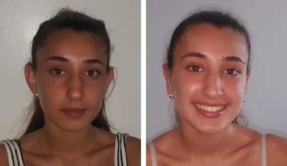 Otoplasty