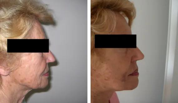 Facelift