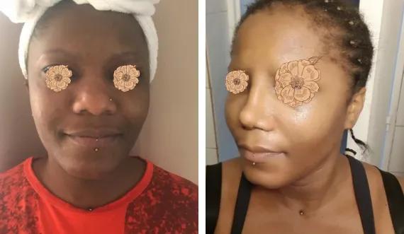 Ethnic Rhinoplasty (1)