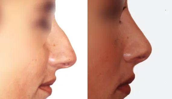 Rhinoplasty (1)