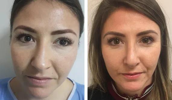 Rhinoplasty (2)
