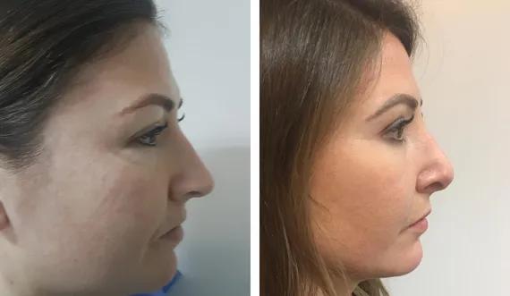 Rhinoplasty (3)