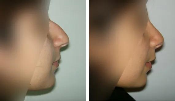 Rhinoplasty (4)