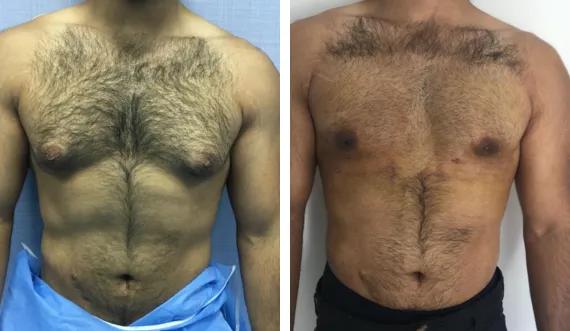 Gynecomasty