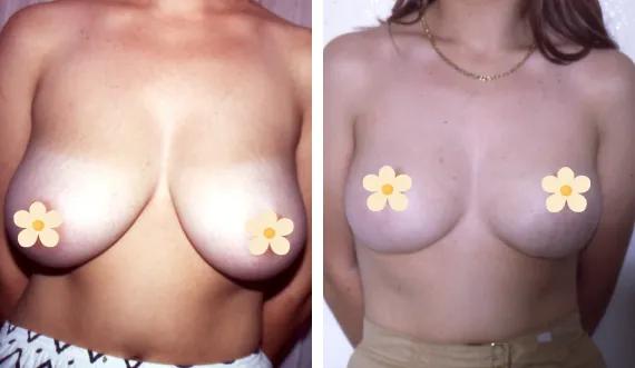 Breast lift witout implant (1)