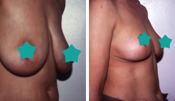 Breast lift witout implant (2)