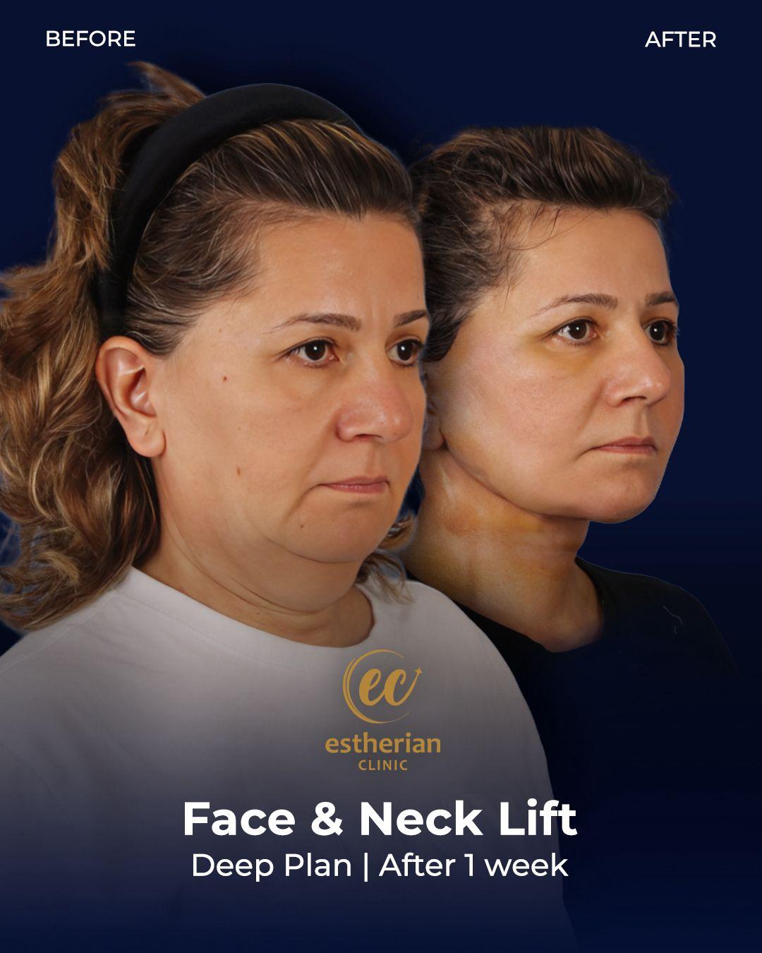 Face lift Turkey 