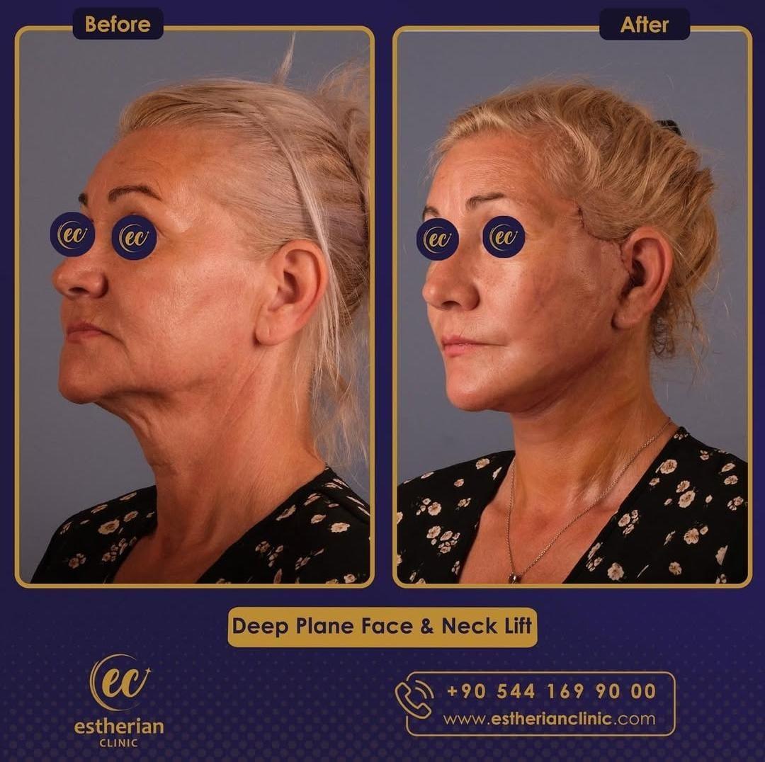 Face lift Turkey 