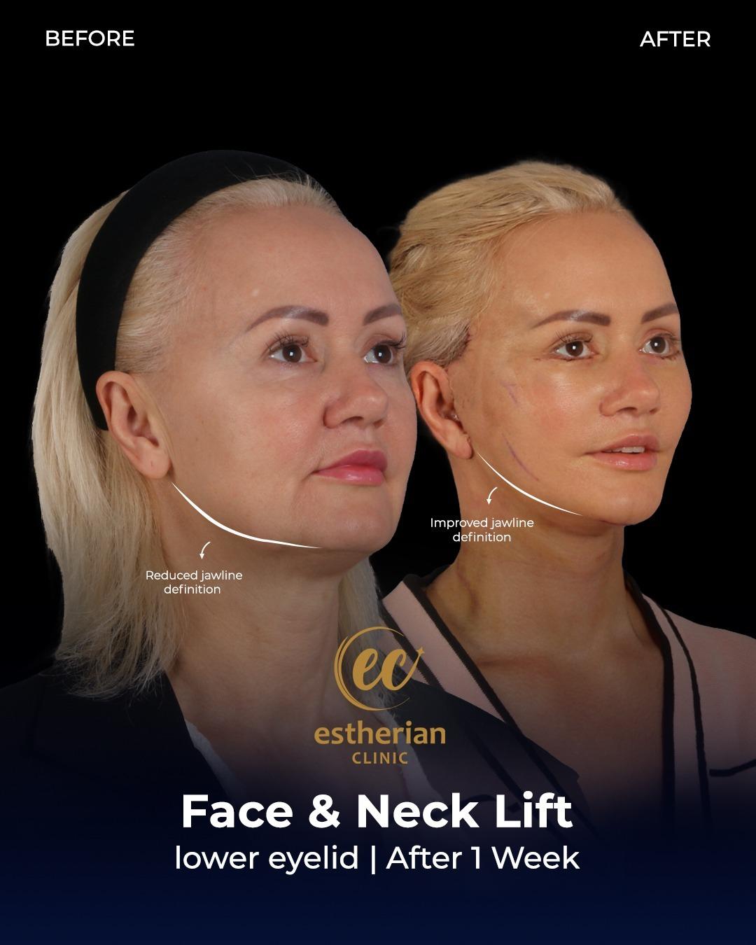 Face lift Turkey 