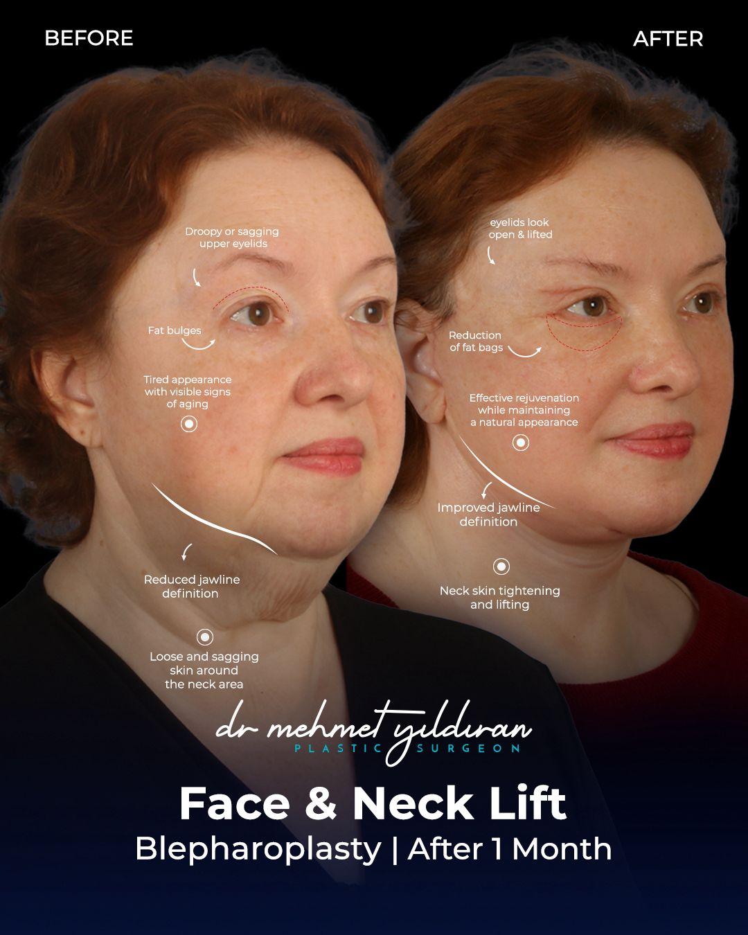 Face lift Turkey 