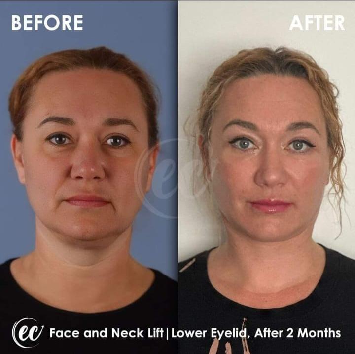 Face lift Turkey 