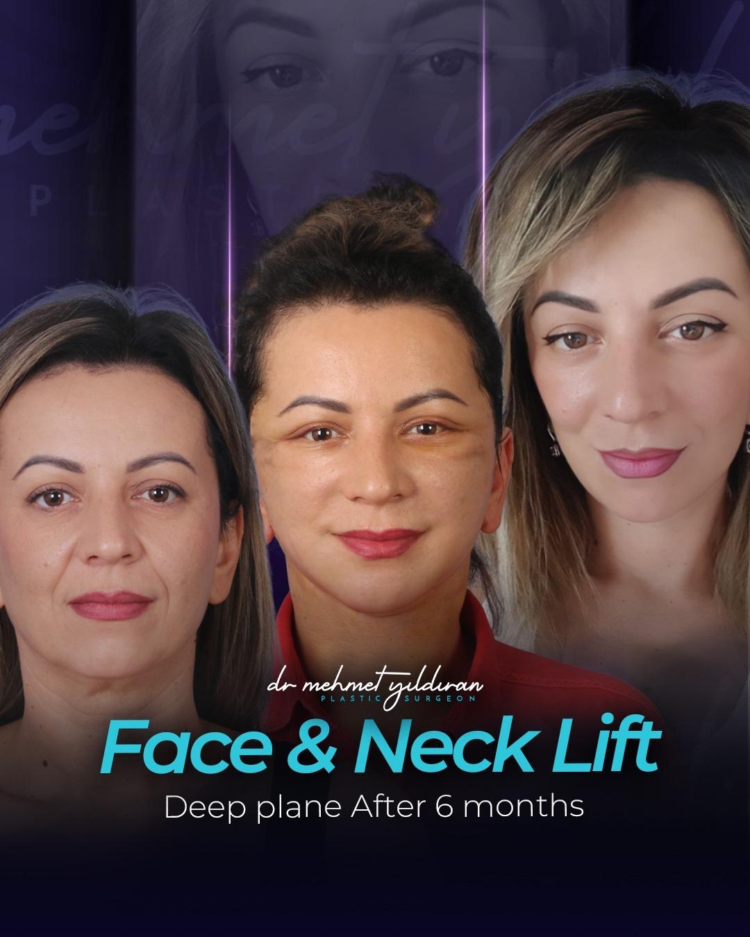 Face lift Turkey 