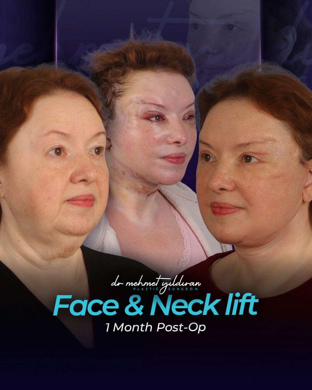 Face lift Turkey 
