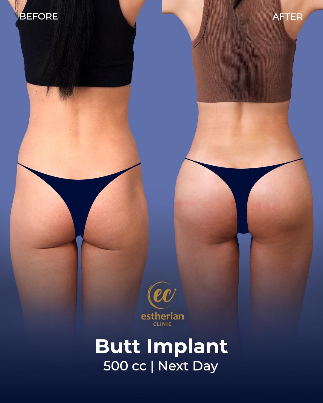 Buttocks Implants Turkey 