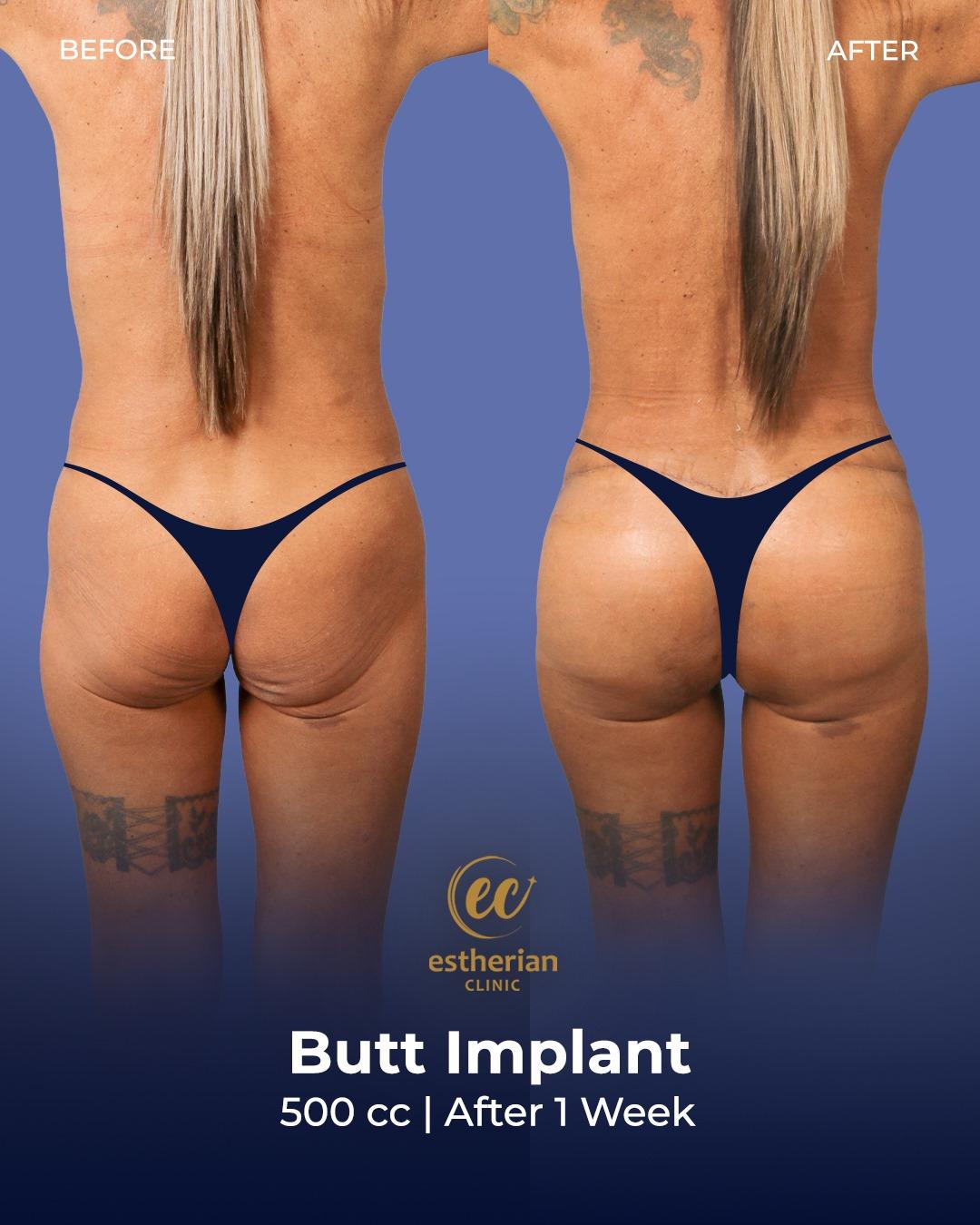 Buttocks Implants Turkey 